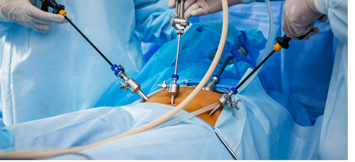 Complexities of Laparoscopic surgery